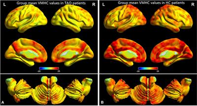 Reduction of Interhemispheric Homotopic Connectivity in Cognitive and Visual Information Processing Pathways in Patients With Thyroid-Associated Ophthalmopathy